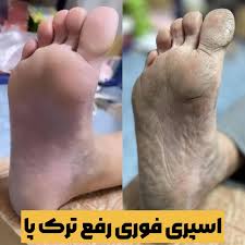 اسپری ترک پا راکو
